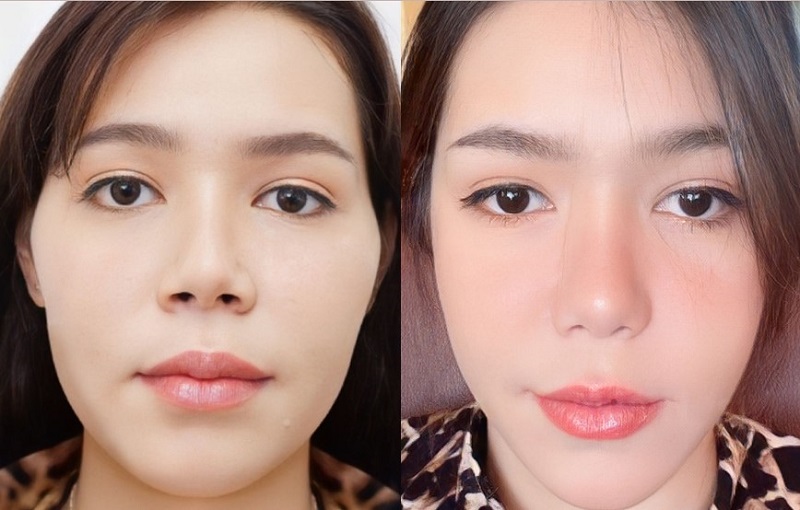 Khách hàng gặp tình trạng gò má cao. thô