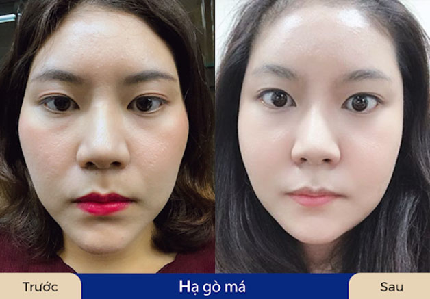 Hạ gò má giúp khách hàng trẻ trung hơn