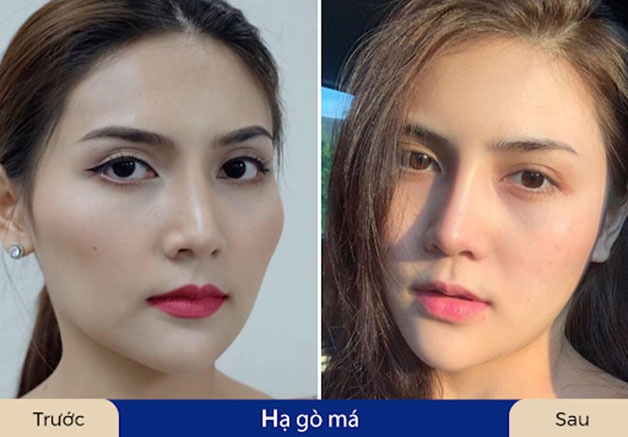 Hóa "nữ thần" sau khi hạ gò má cao tại Kangnam