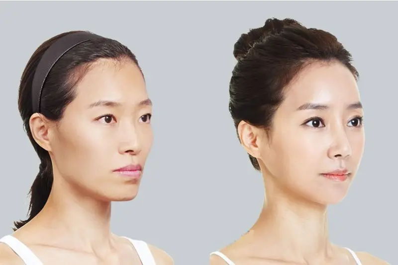 Kỹ thuật tiêm chuẩn giúp gò má cân đối và nhanh ổn định