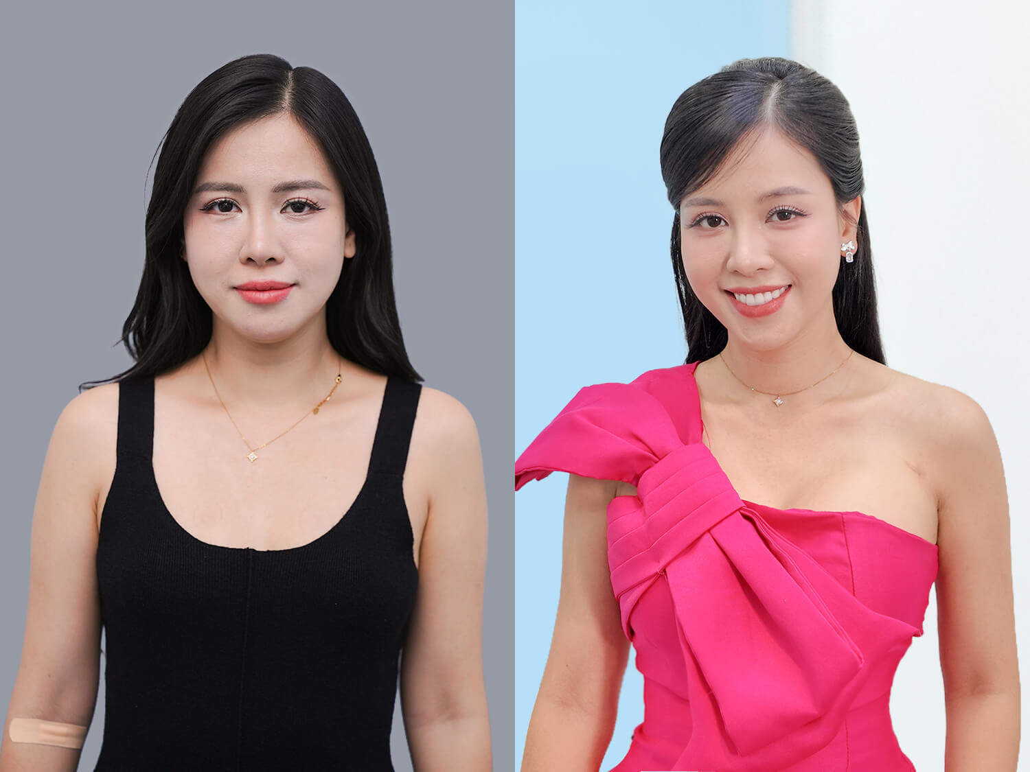 Khách hàng Hoàng Yến sở hữu vòng 1 tự nhiên, to tròn sau nâng ngực