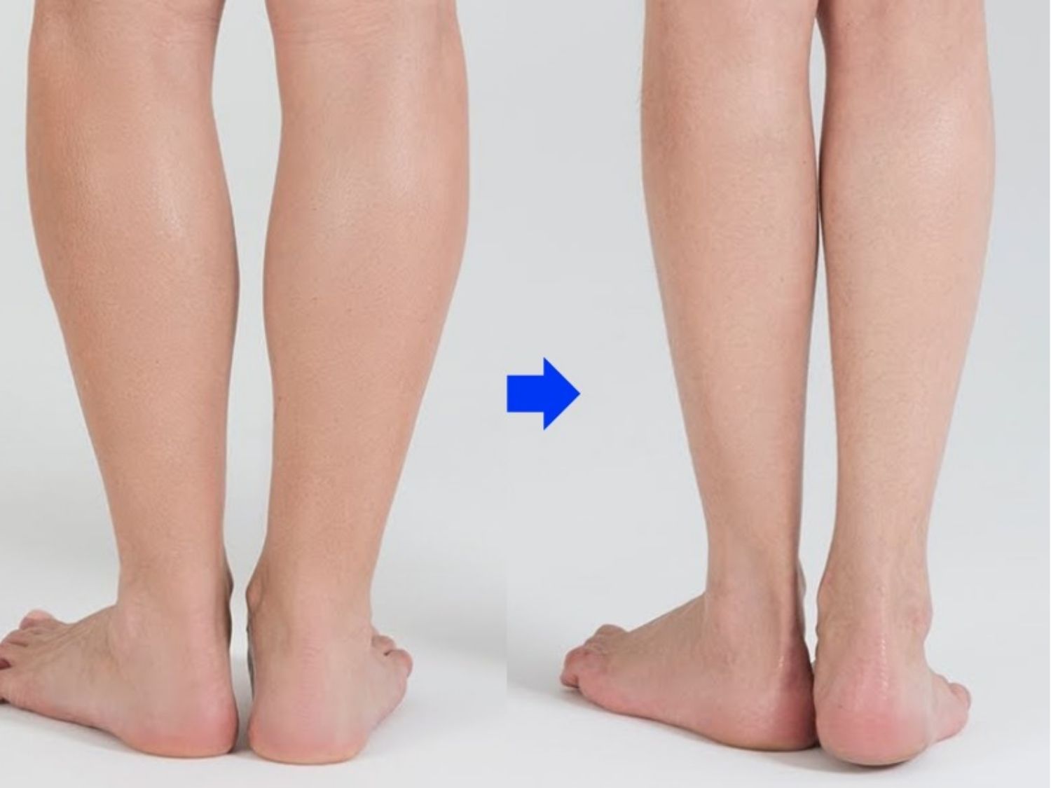 nhiều mỡ thừa ở bắp chân