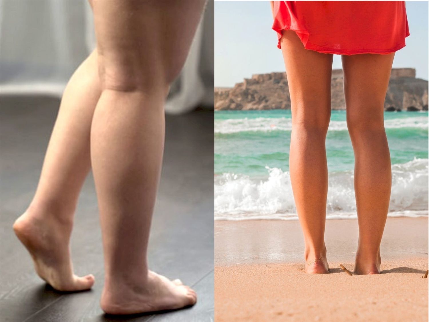 Mỡ bắp chân  là lớp mô mỡ thừa tích tụ dưới da ở vùng bắp chân