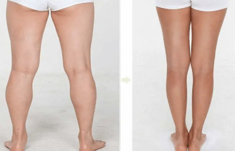 hút mỡ giúp khách hàng sở hữu bắp chân thon gọn, an toàn