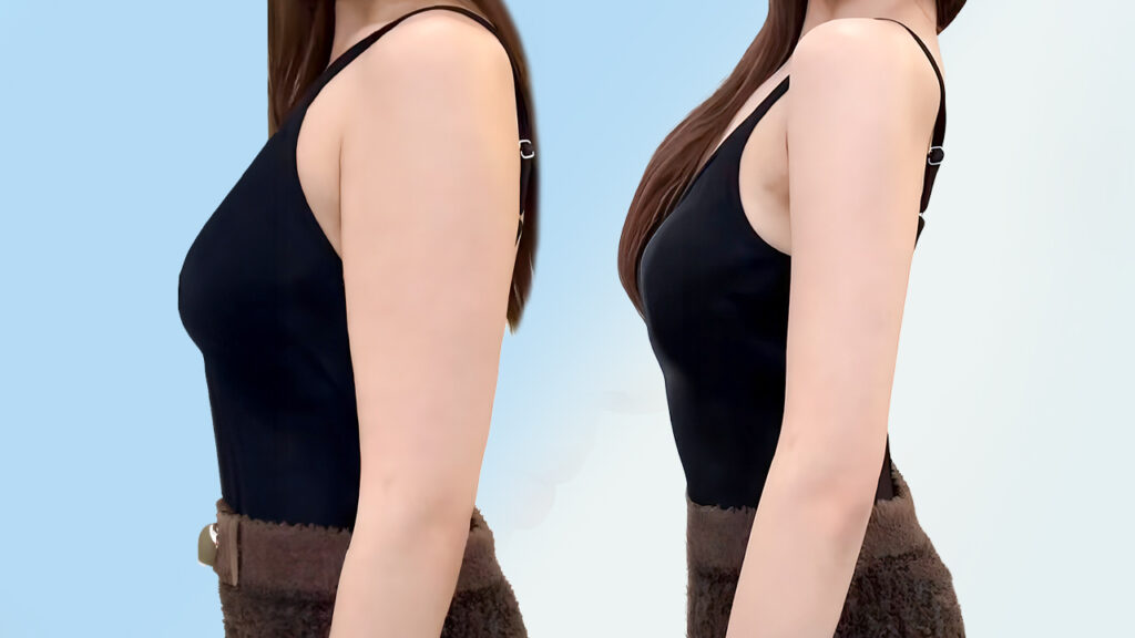 Hút mỡ bắp tay là gì? có đau không, có nguy hiểm không, giá bao nhiêu tiền