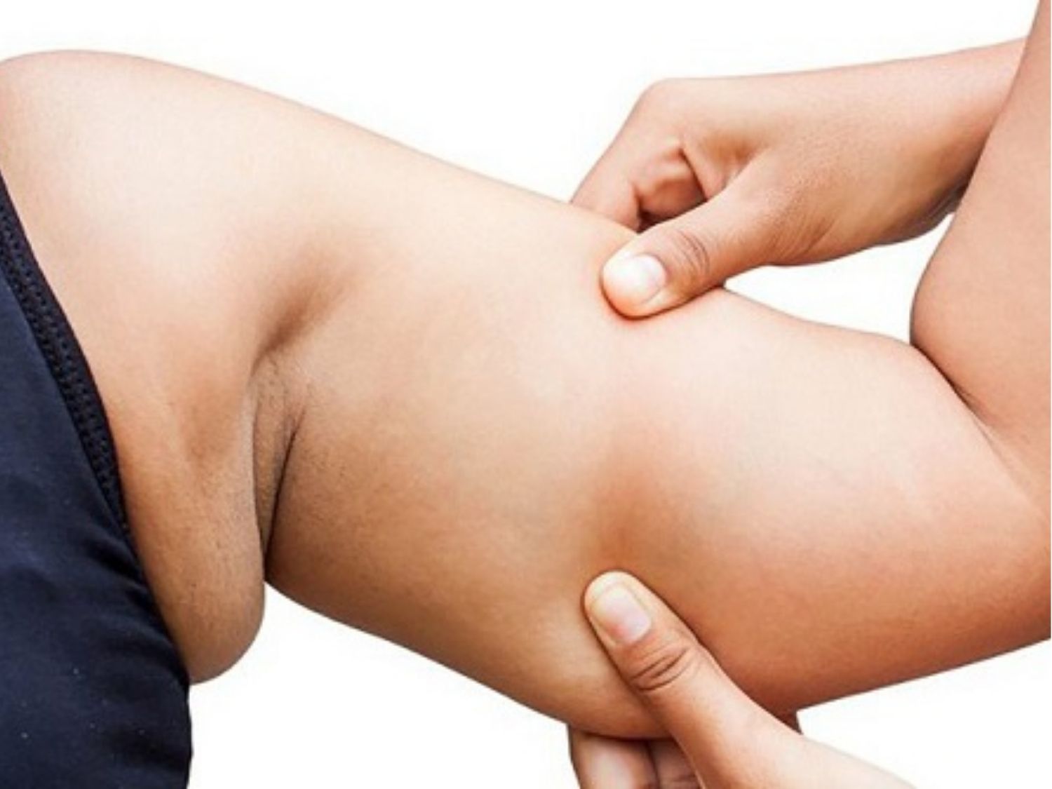 Mỡ bắp tay là lớp mỡ thừa tích tụ ở phần trên cánh tay