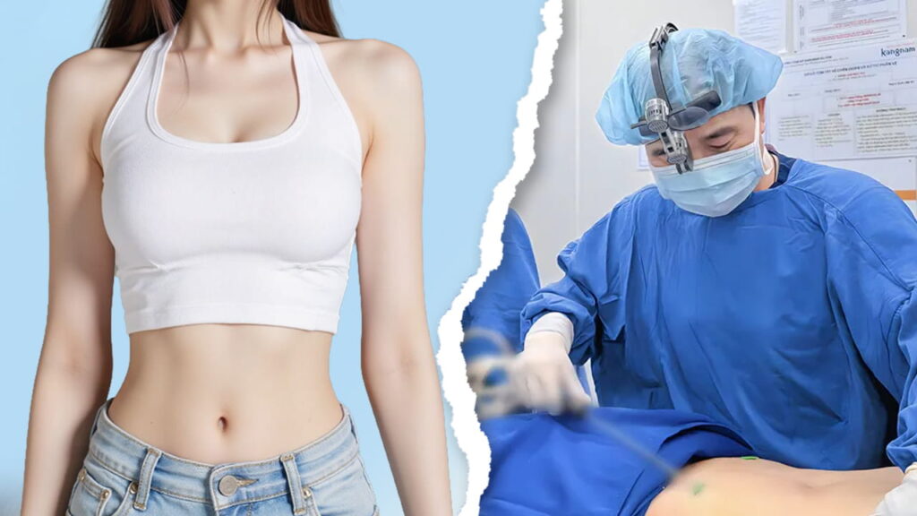 Hút Mỡ Bụng: Giải Pháp Cho Vóc Dáng Thon Gọn Hoàn Hảo