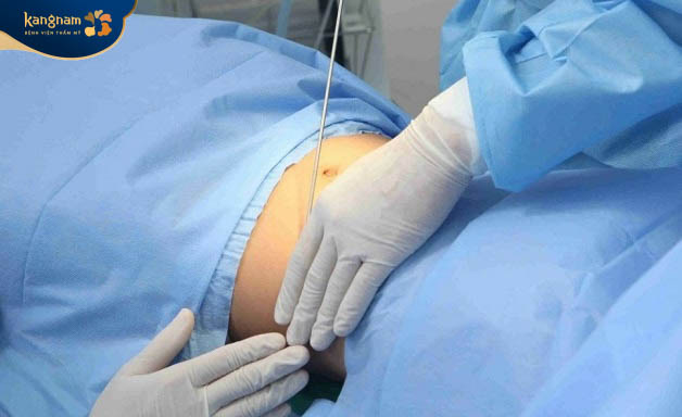 Hút mỡ bụng kiêng quan hệ từ 4 - 6 tuần