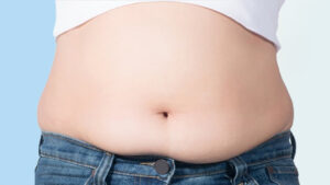 Hút Mỡ Bụng Cho Nam Giới: Loại bỏ bụng phệ , bụng bia