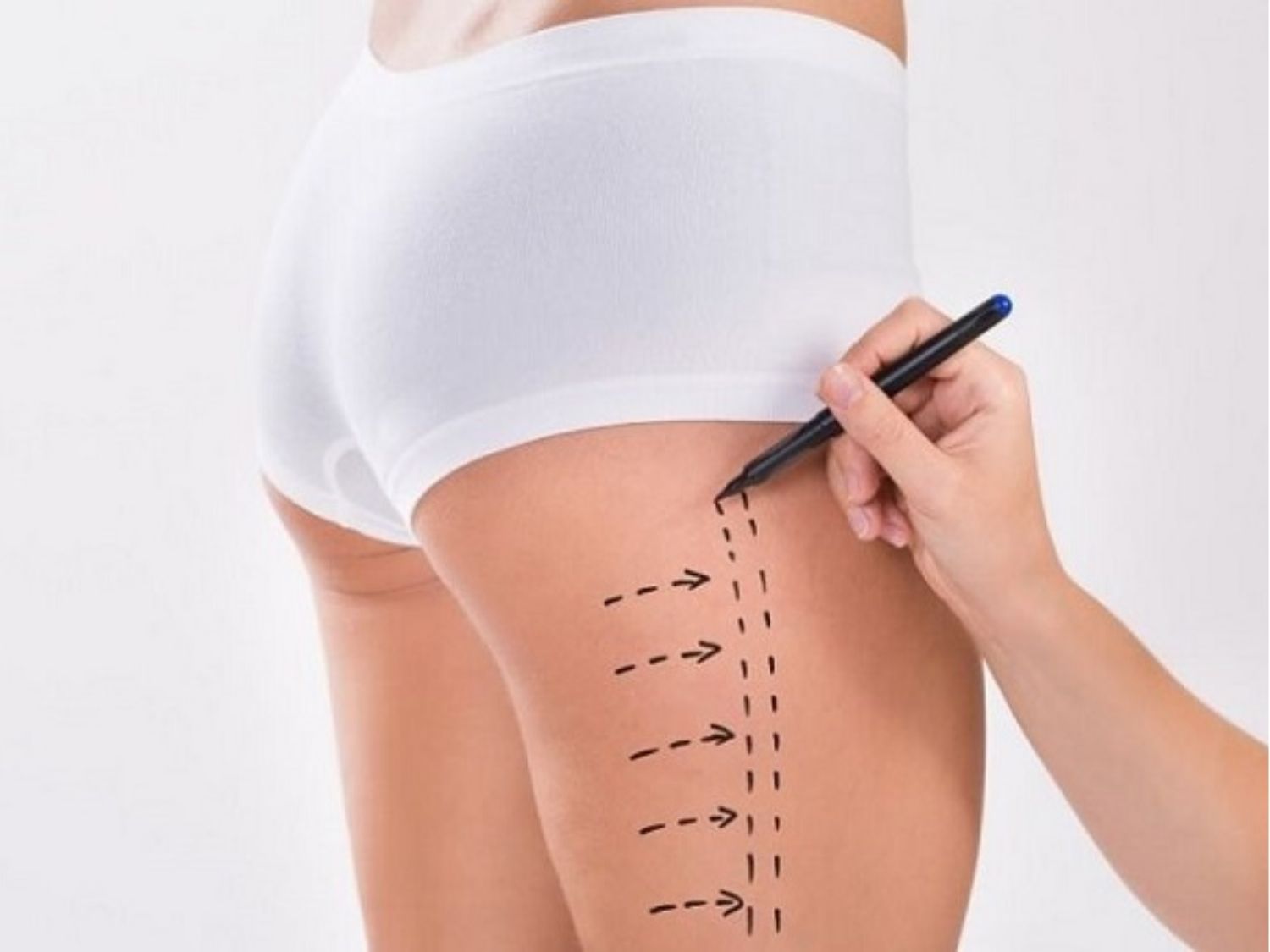 Hút mỡ đùi tại các cơ sở uy tín rất nhẹ nhàng