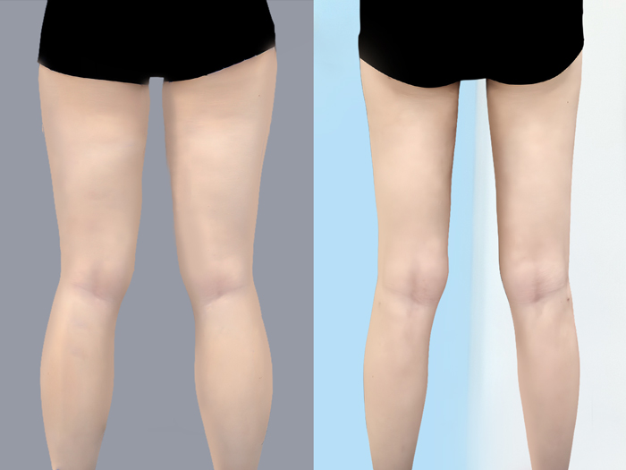 khách hàng trước vá sau khi hút mỡ đùi, loại bỏ đùi to thô kệch, sở hữu vòng đùi thon gọn