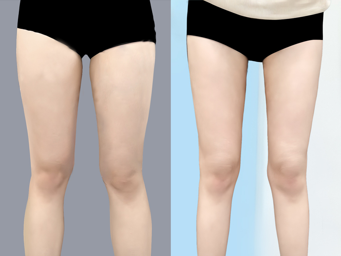 Hút mỡ đùi giảm nhanh sau 1 lần thực hiện