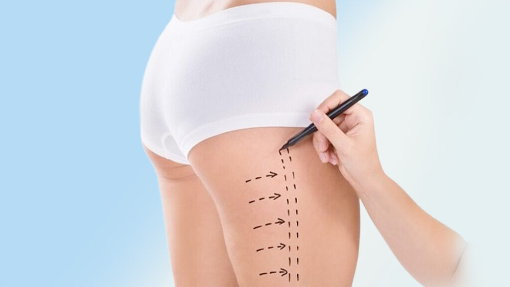 Hút mỡ đùi là gì? Hút mỡ đùi có nguy hiểm không, phương pháp hút mỡ hiệu quả