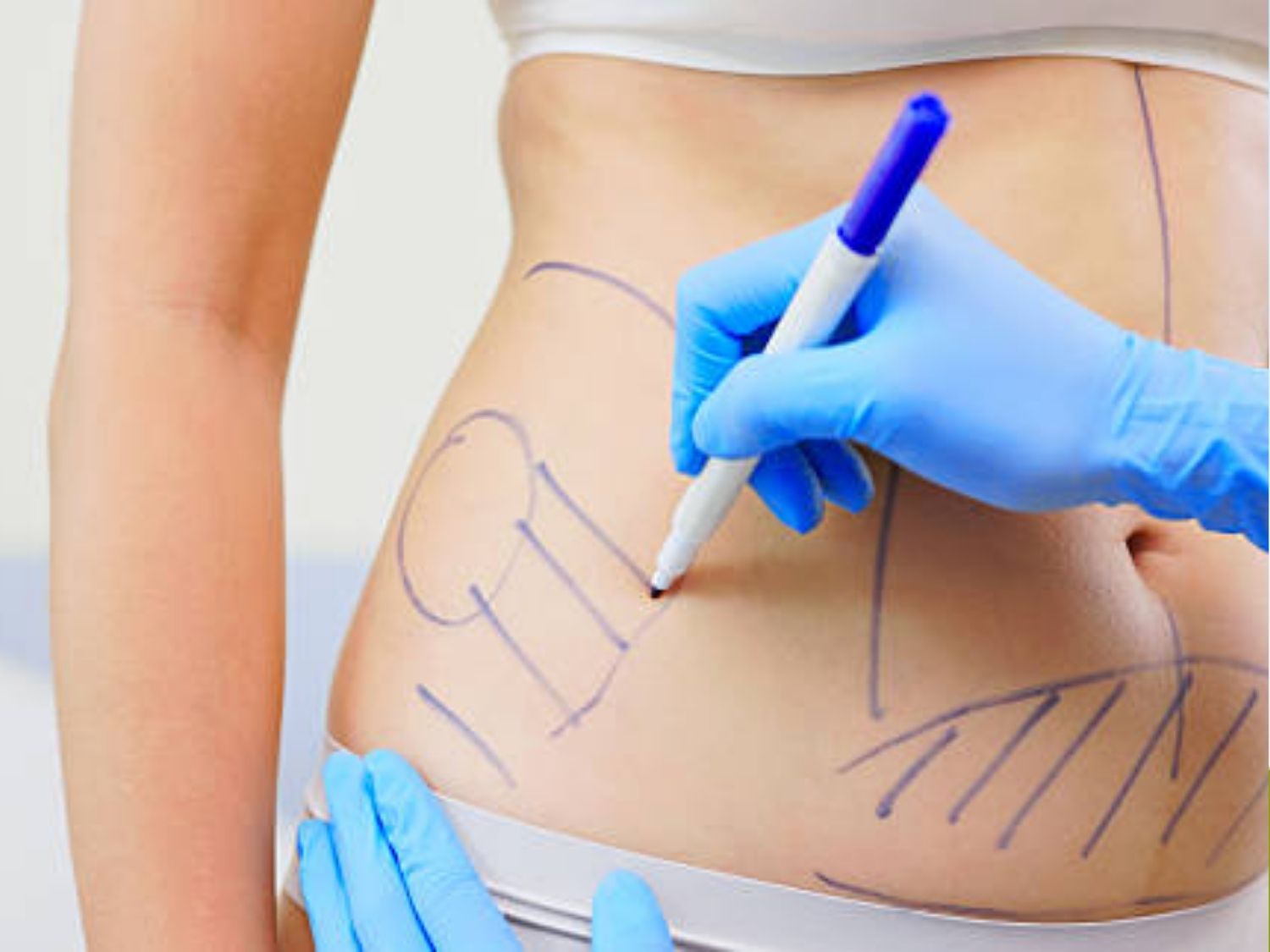 hút mỡ là thủ thuật cần thực hiện trong phòng vô trùng