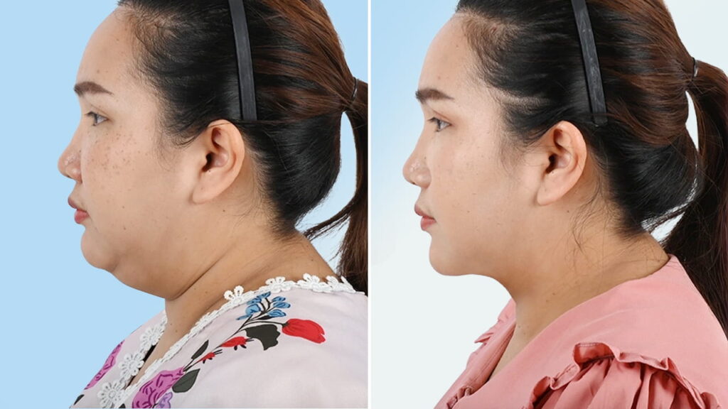 Hút mỡ mặt là gì? Giảm mỡ mặt hiệu quả: Bác sĩ Felix Trần tư vấn