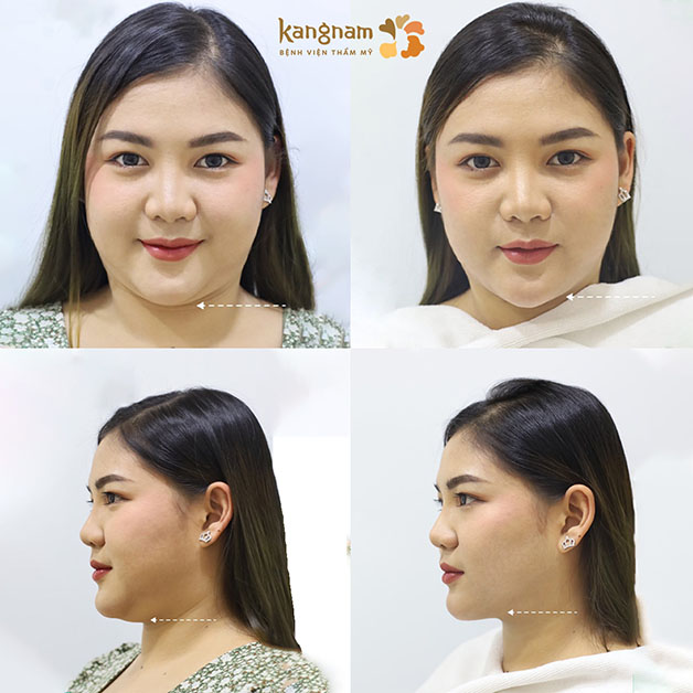 Mặt nhẹ hẳn sau khi giảm mỡ, có ngay cằm Vline