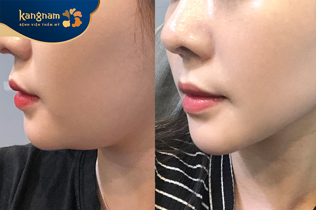 Hút mỡ giúp gương mặt thanh thoát hơn