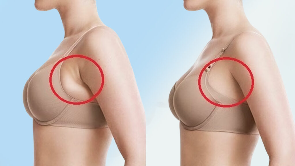 Hút Mỡ Nách: Giải Pháp An Toàn và Hiệu Quả Loại Bỏ Mỡ Thừa Vùng Nách