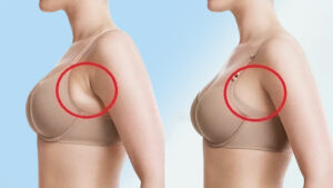 Hút Mỡ Nách: Giải Pháp An Toàn và Hiệu Quả Loại Bỏ Mỡ Thừa Vùng Nách