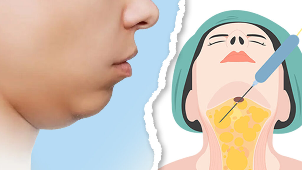 Hút mỡ nọng cằm – Loại bỏ 90% mỡ, giúp gương mặt thanh thoát