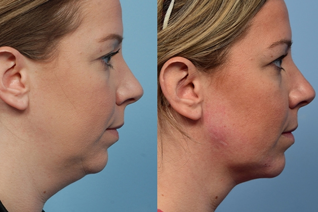 Hút mỡ cằm loại bỏ mỡ nhanh chóng