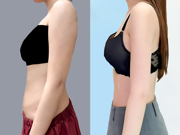 khách hàng sau khi hút mỡ bắp tay sở hữu bay tay thon gọn và nâng cao tính thẩm mỹ