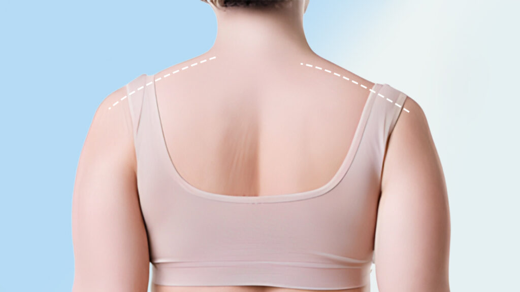 Hút mỡ vai: Quy trình, chi phí và cách đảm bảo an toàn