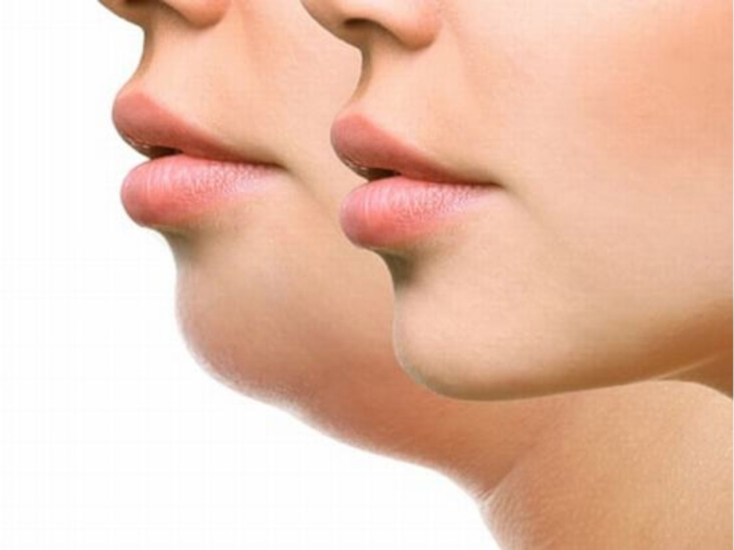 Người có mỡ thừa tích tụ nhiều ở vùng cằm