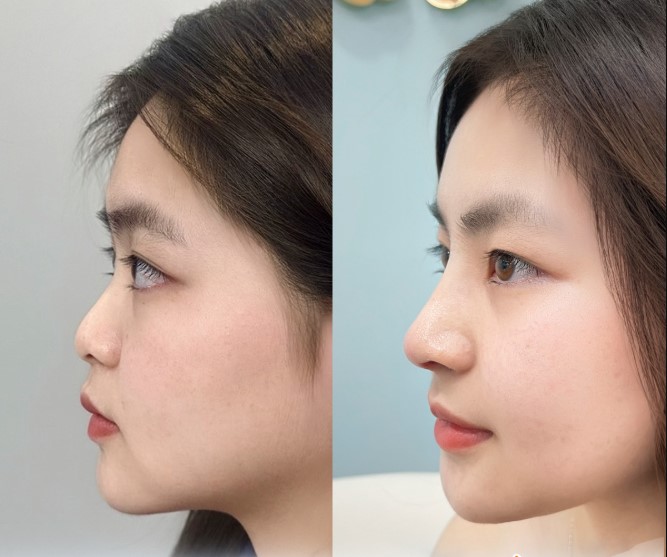 Dáng mũi cao thon gọn, tự nhiên và hài hòa