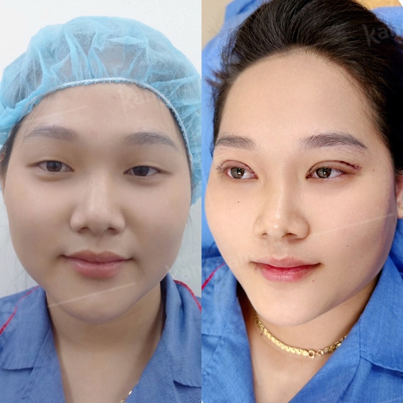 Mí mắt đẹp, rõ sau khi cắt tại Kangnam Nghệ An