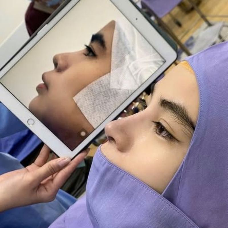 Mũi cao thanh tú, tự nhiên