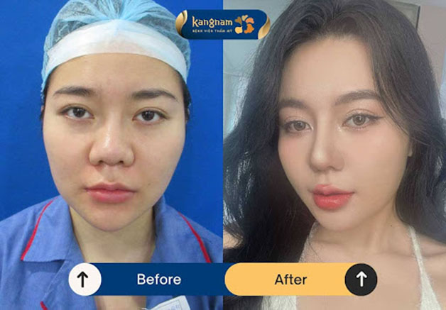 Mũi thon gọn và có điểm nhấn sau khi thu nhỏ cánh mũi