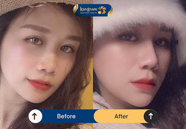 Dáng mũi cao, thon gọn và sắc nét