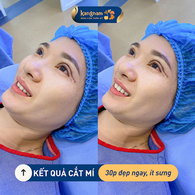 Khách hàng sau 30 phút cắt mí tại Kangnam