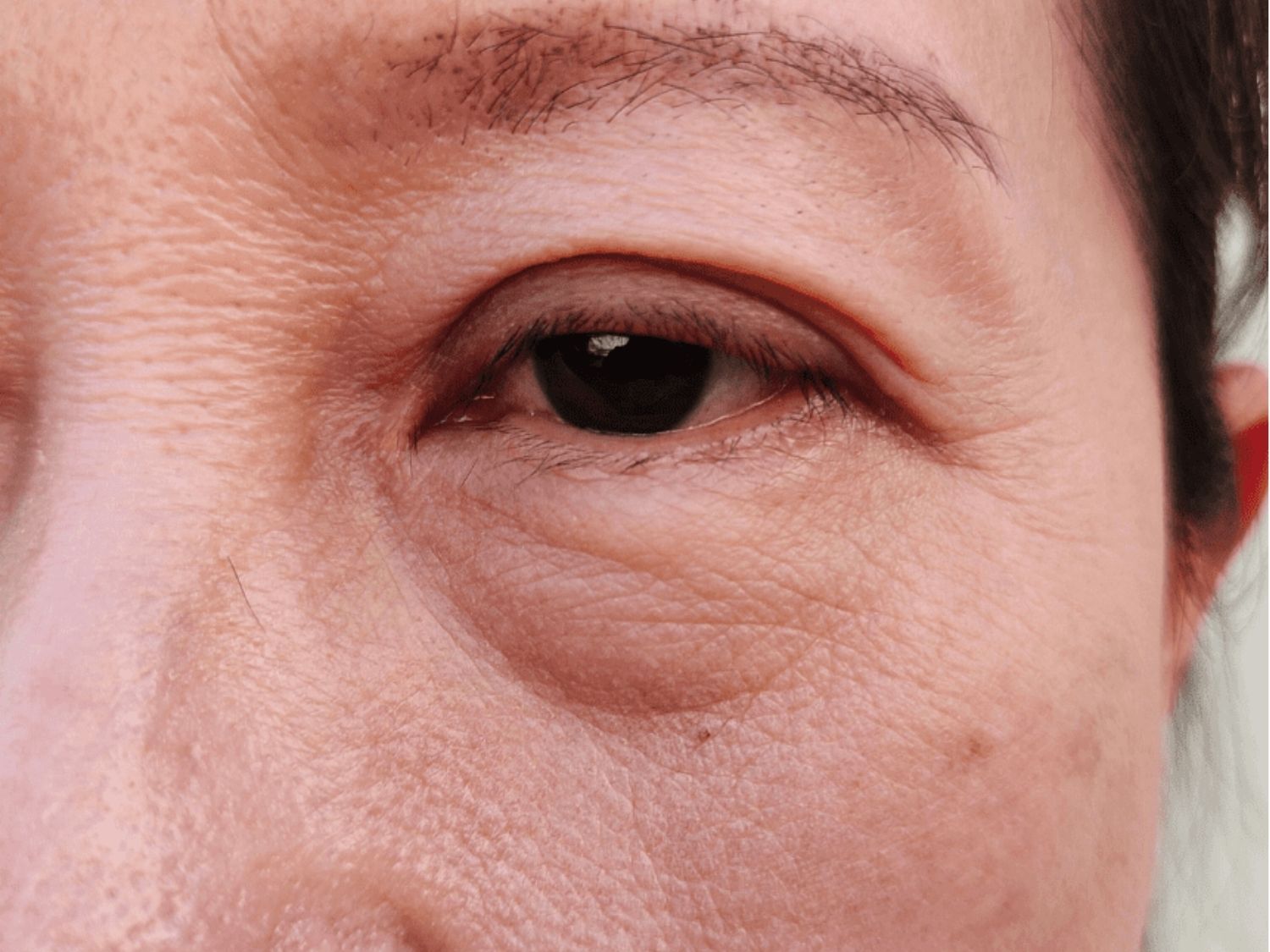 Mỡ bọng mắt là tình trạng vùng da dưới mắt bị tích mỡ và sưng phồng nhẹ