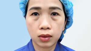 Lấy mỡ bọng mắt là gì? Phương pháp, chi phí và những điều cần biết