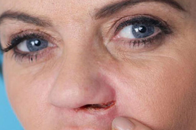 Mũi lộ sẹo sau khi cắt cánh mũi