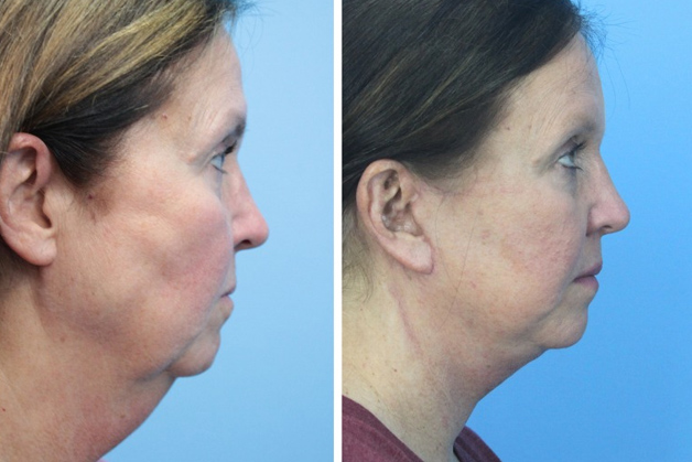 Loại bỏ các cụm mỡ không mong muốn trên các vùng như má, cằm, và cổ