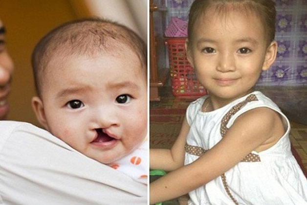 Cải thiện ngoại hình, diện mạo và cấu trúc khuông mặt cho trẻ