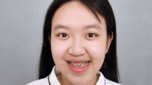 Mặt Bị Lệch Là Như Thế Nào? Nguyên Nhân, Tác hại Và Cách Khắc Phục