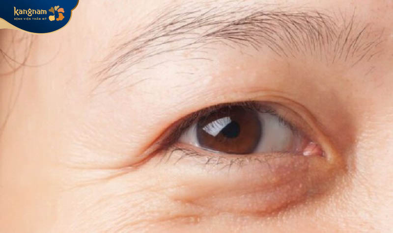 Hiện tượng mắt bị sụp mí sau khi ngủ dậy rất phổ biến