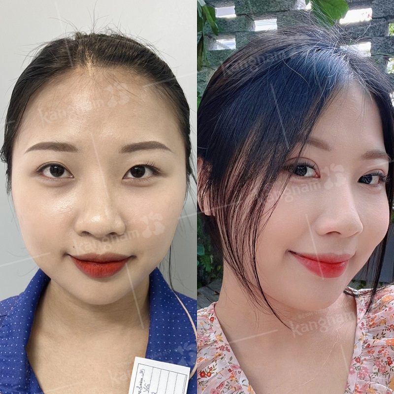 Cắt mí giúp đôi mắt rõ nét, tươi trẻ hơn