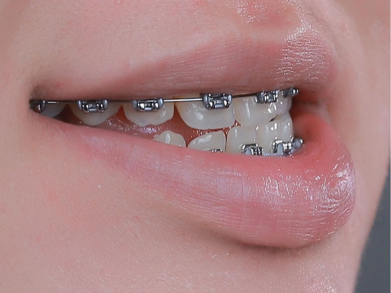 Niềng răng có thể giúp cải thiện tình trạng mặt lưỡi cày