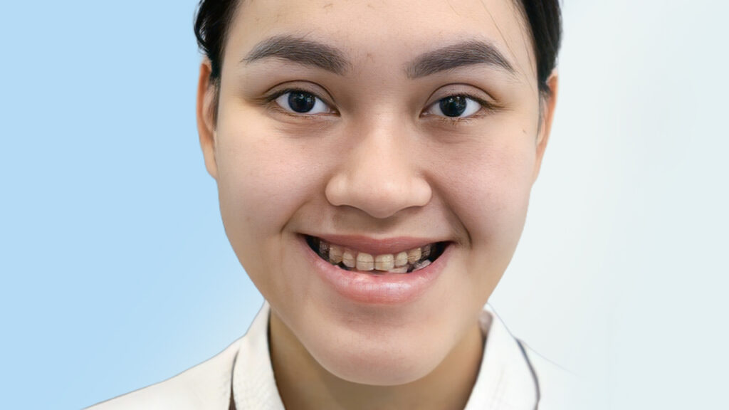 Mặt lưỡi cày: Tướng đẹp hay xấu? Xem tướng số & chọn kiểu tóc phù hợp