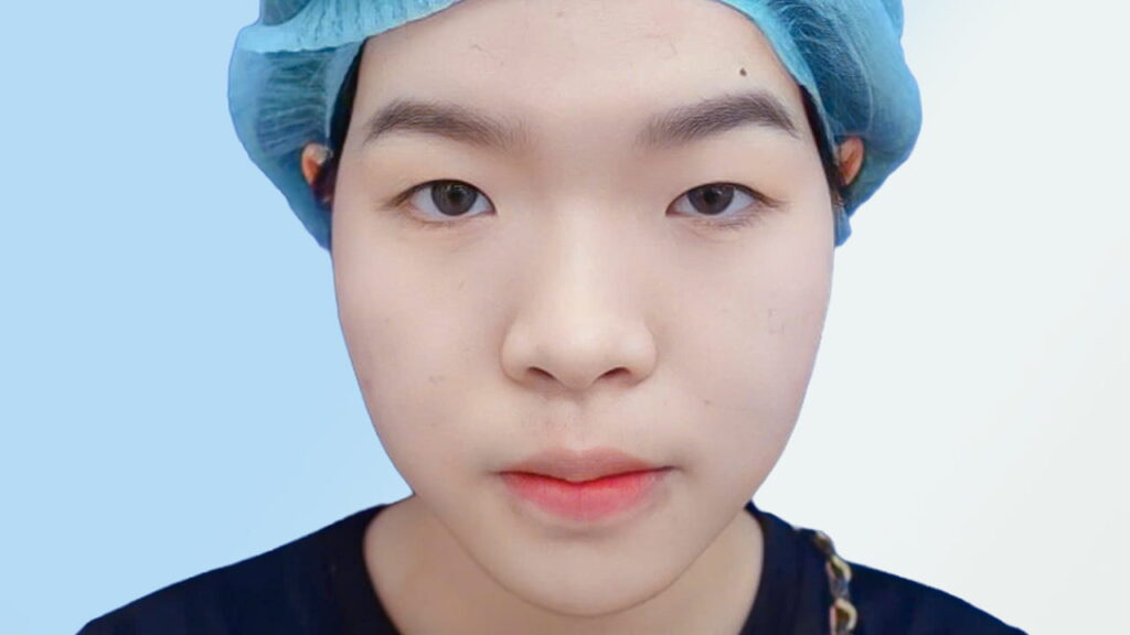 Mắt một mí là gì? Đặc điểm, nguyên nhân và cách cải thiện thẩm mỹ