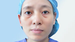 Mắt to mắt nhỏ là gì? Nguyên nhân và cách khắc phục hiệu quả