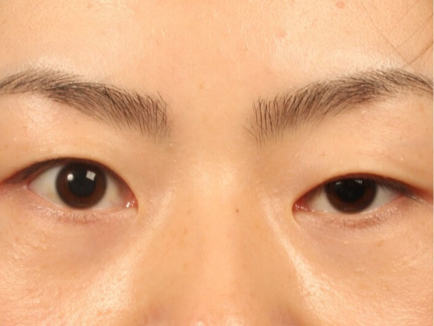 Mắt to mắt nhỏ là 2 bên mí mắt không đều