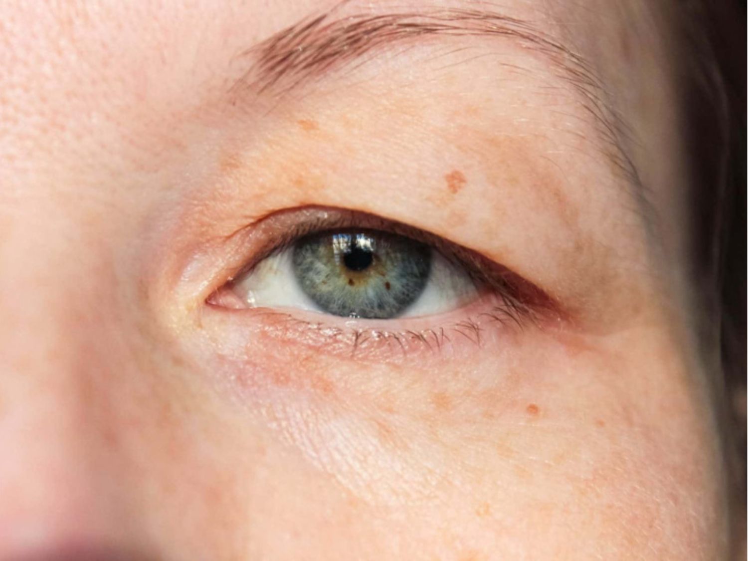 Lão hóa khiến mắt không cân đối