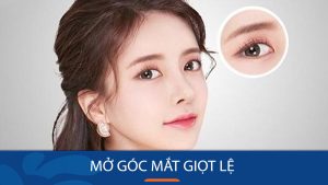Mở góc mắt giọt lệ là gì? Lợi ích, quy trình & những điều cần biết