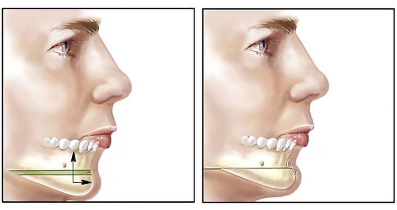 Mô phỏng kỹ thuật trượt cằm giúp thay đổi hoàn toàn cấu trúc gương mặt từ cằm lẹm sang dáng V-line thanh thoát bằng xương tự thân.